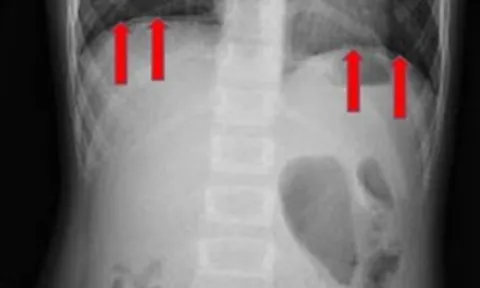 TPHCM: Phát hiện bé gái 8 tuổi thủng ruột nặng sau cơn đau bụng ở trường