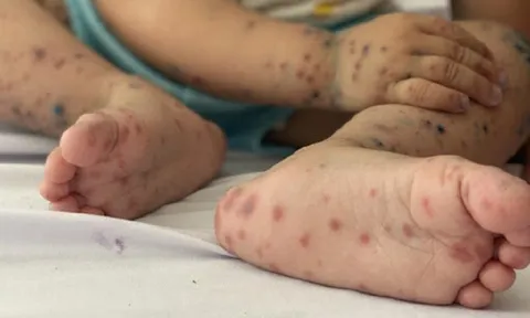 Tp.HCM: Dịch bệnh tay chân miệng gia tăng, người dân cần làm gì?