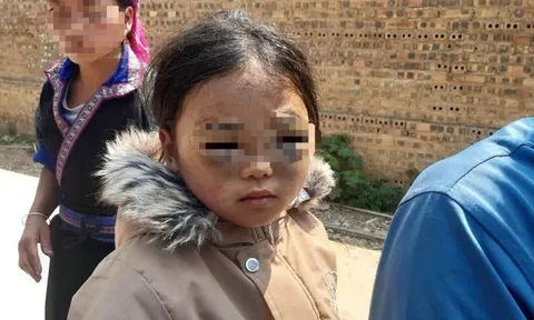 Yên Bái: Bé gái lớp 1 bị thâm tím mắt do cô giáo dùng thước gõ lên đầu?