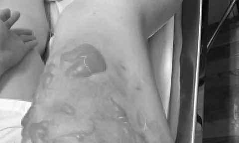 TPHCM: Cô gái phải cấp cứu ở 2 bệnh viện vì tai nạn nguy hiểm khi ăn lẩu