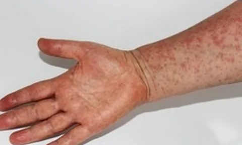 Dịch sởi lan rộng khiến hàng chục trẻ em tử vong, một quốc gia triển khai chiến dịch tiêm chủng khẩn cấp