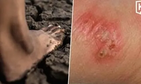 Thái Lan cảnh báo khẩn về dịch "sốt đất": 732 ca nhiễm, 23 trường hợp tử vong